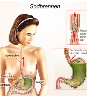 Sodbrennen Ursachen