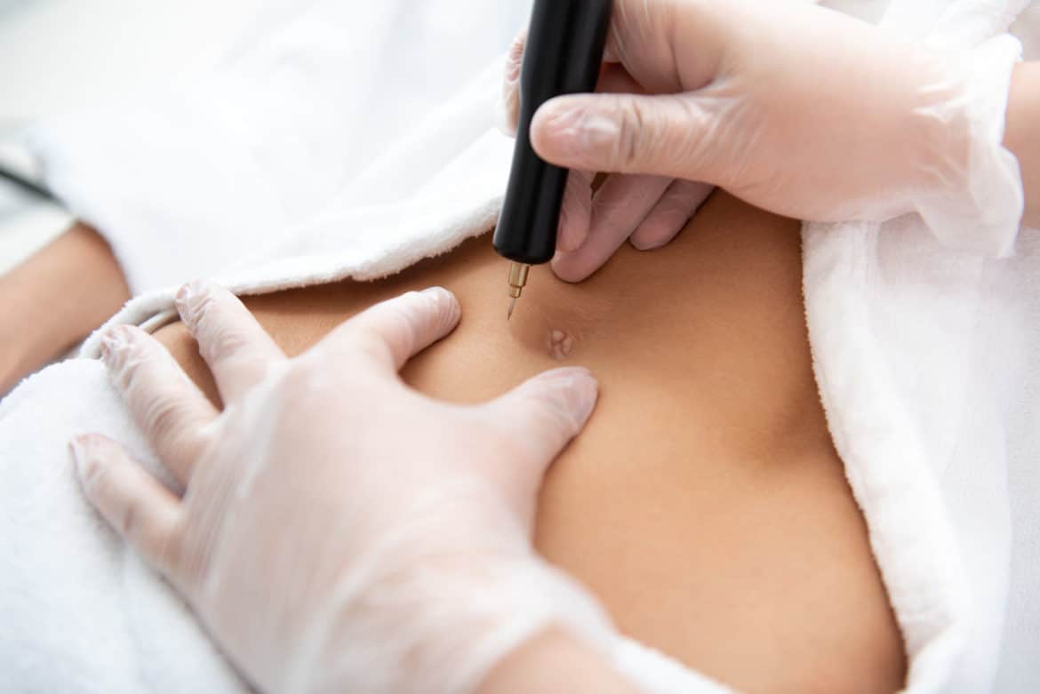 Risiken bei der Bauchnabelkorrektur