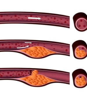 Arteriosklerose