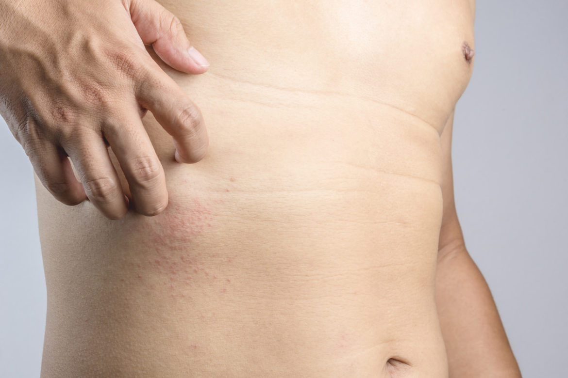 Ausschlag am Bauch