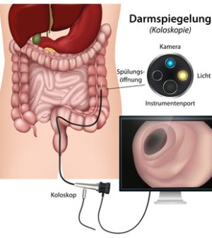 Darmspiegelung
