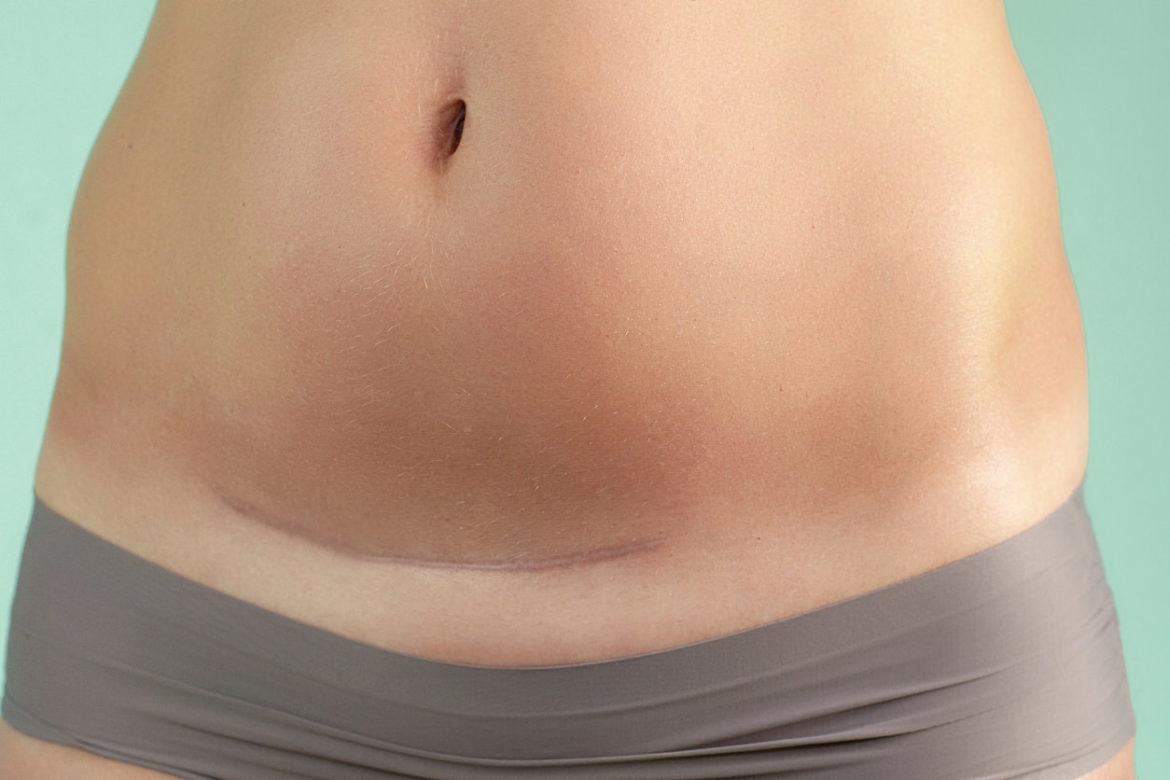 so sieht die Narbe bei einem Kaiserschnitt aus